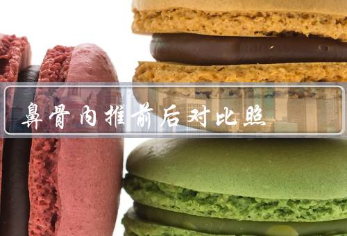 鼻骨内推前后对比照，作用／意义／小结